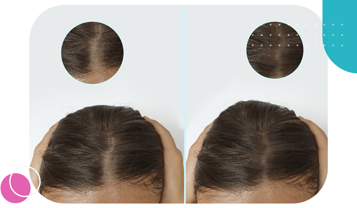 Scalp Micropigmentation
