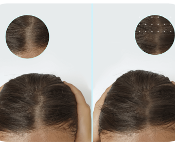 Scalp Micropigmentation