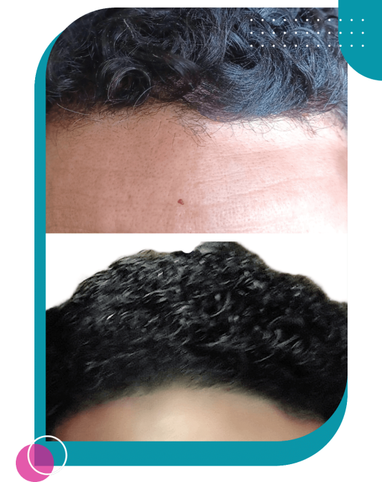 Hairline Microblading by Browwell