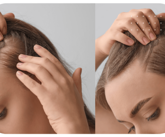 microblading hairline